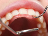 natural-treatment-gum-disease