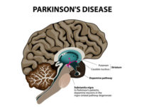 parkinsons-disease