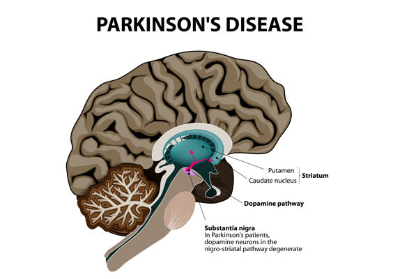 parkinsons-disease