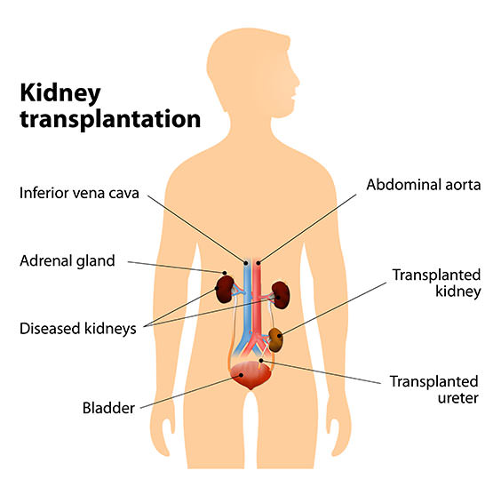 kidney-transplant