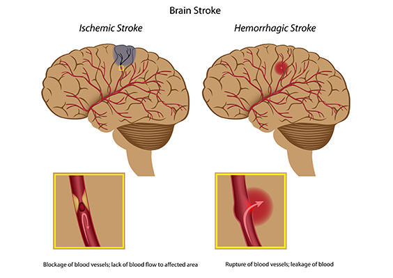 brain-stroke