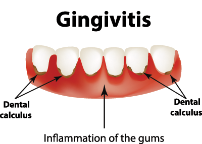 gingivitis